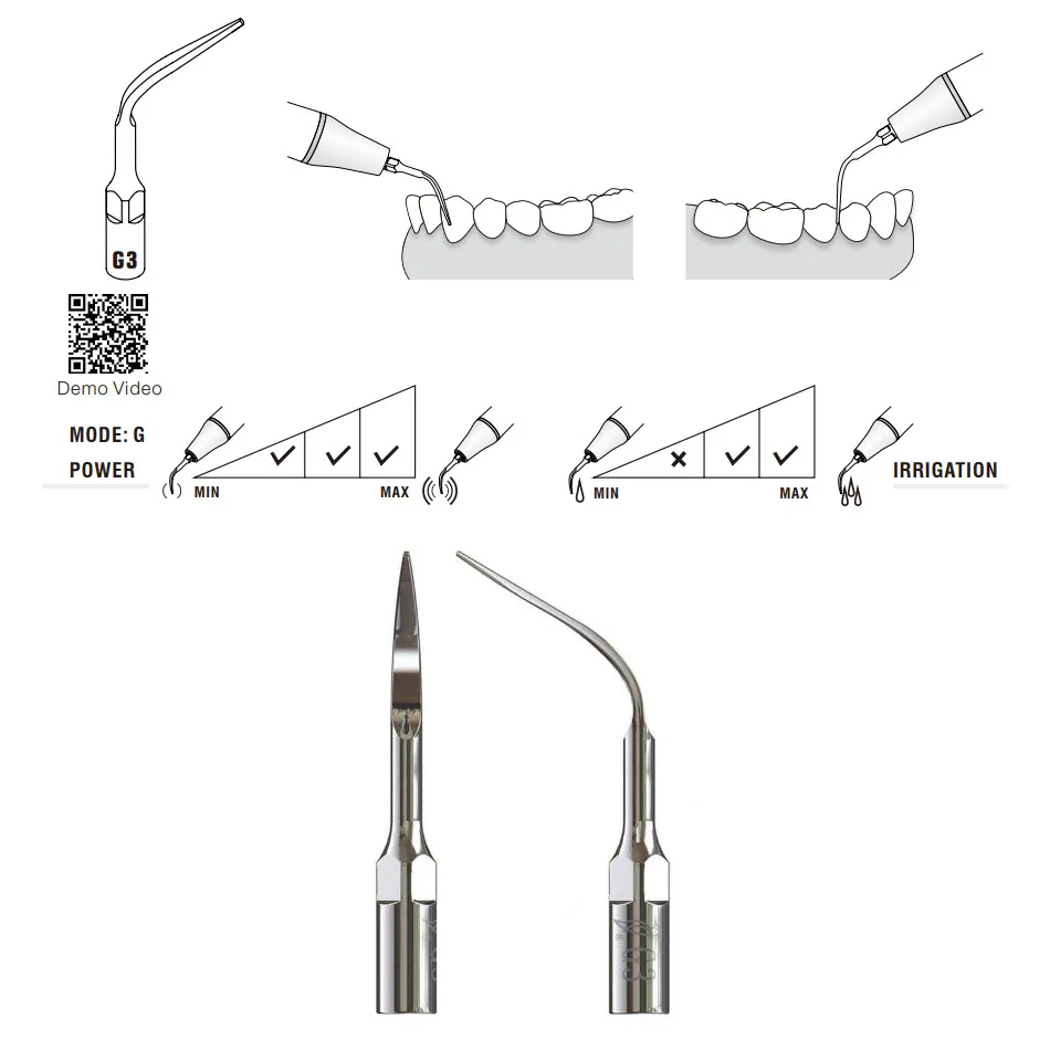 G3 Woodpecker Scaler Tip, Removal of Supragingival Deposit and Interproximal