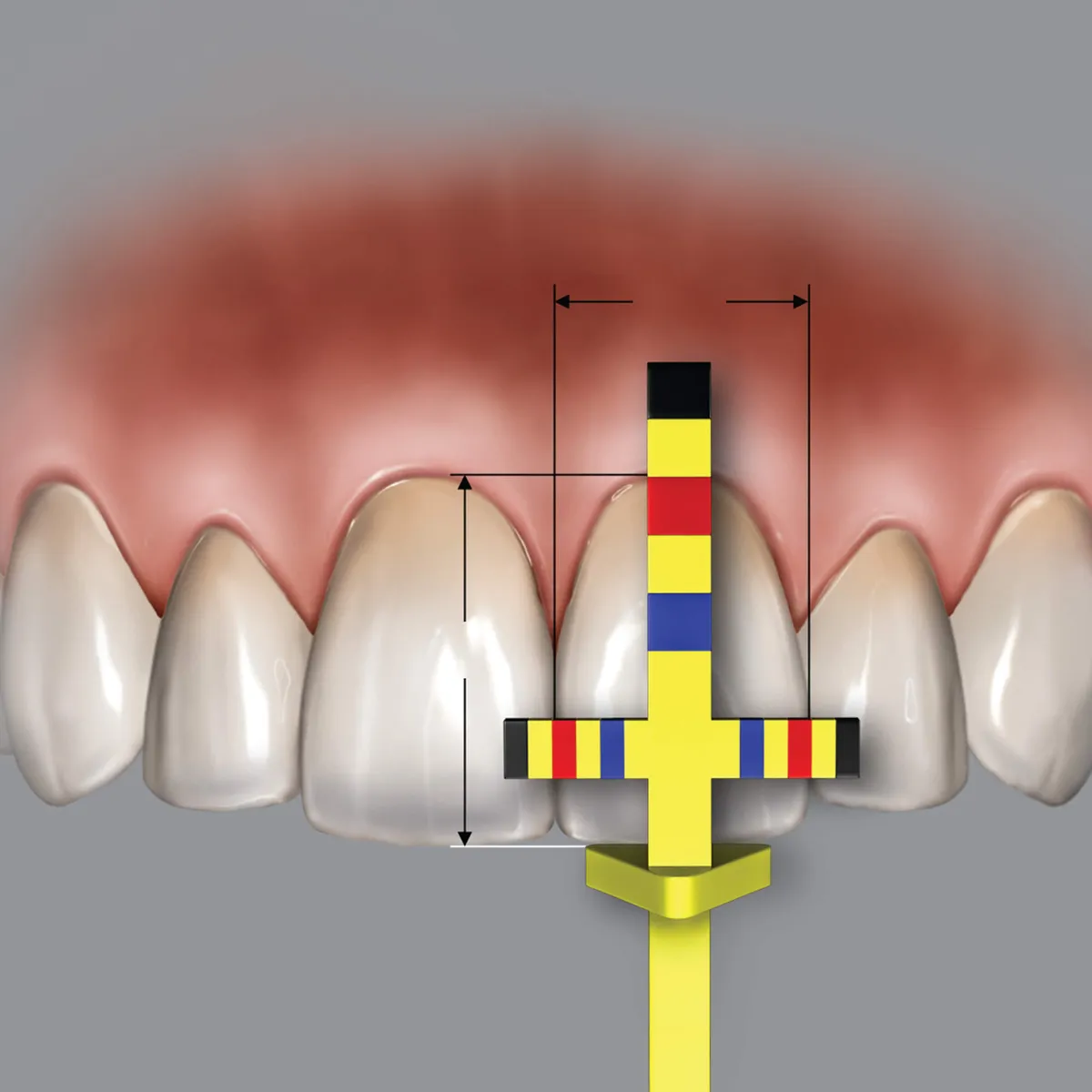 Chu Gauge T-Bar رؤوس بديلة (3 رؤوس)