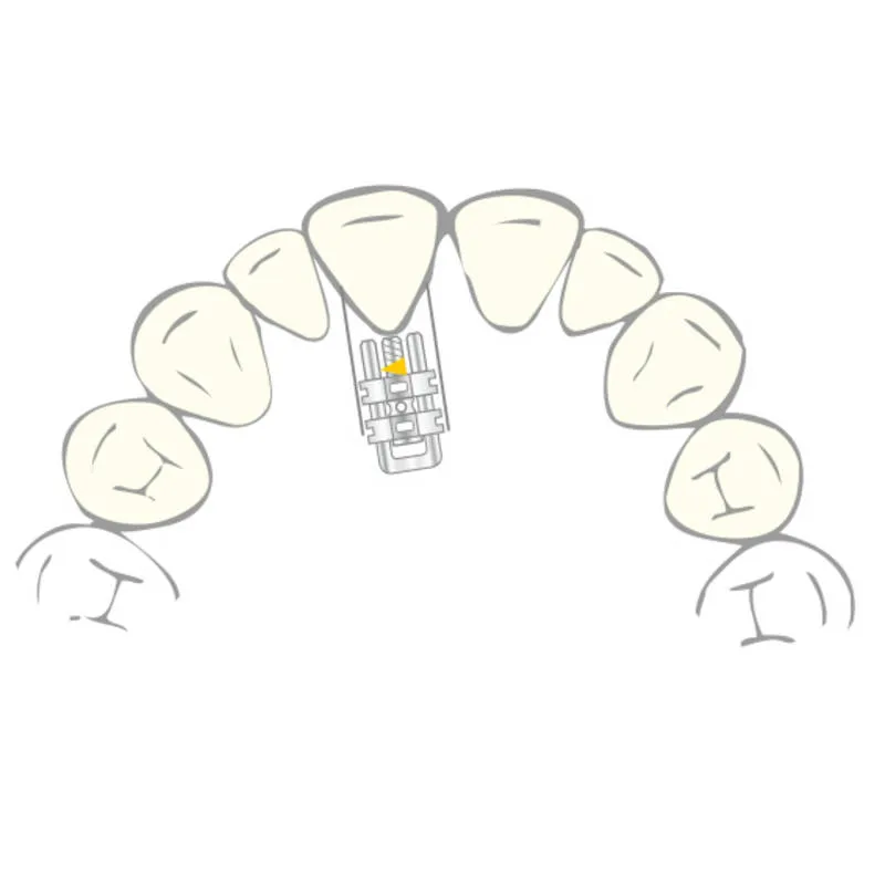 VECTOR 350, Skeletal Expanders, 4mm, PK/10